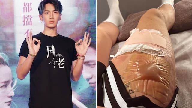 柯震東大腿燙傷「大水泡如水晶餃」！燙傷處理SOP這樣做 人工皮別亂貼/medical/355952