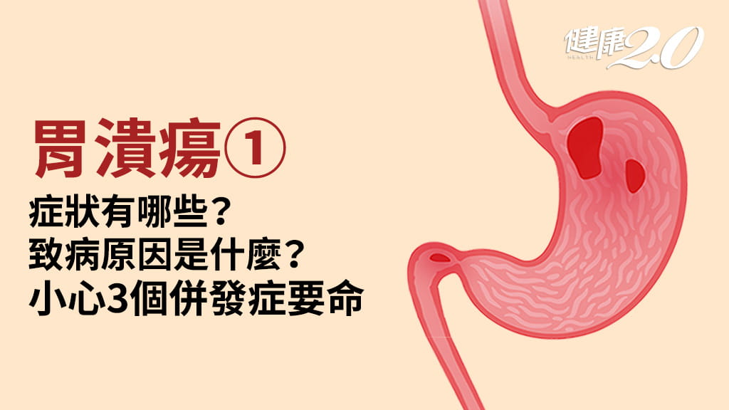 胃潰瘍／為什麼會胃潰瘍？小心轉胃癌！胃潰瘍不一定會胃痛 解黑便要小心