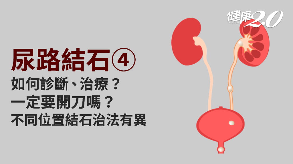 尿路結石／尿路結石需要開刀嗎？該如何診斷？治療方法該如何選擇？