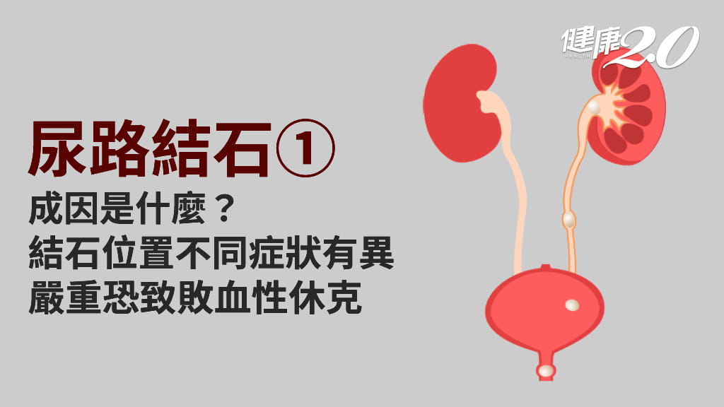 尿路結石／結石痛要人命！夏天發作病人較冬天高3～5倍，爸媽有結石的人小心