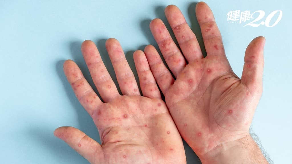 腸病毒高峰期來了、連2周破萬人！預防腸病毒除了洗手 這招保護效果達98％