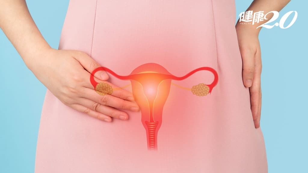 卵巢問題 女性 多囊 子宮