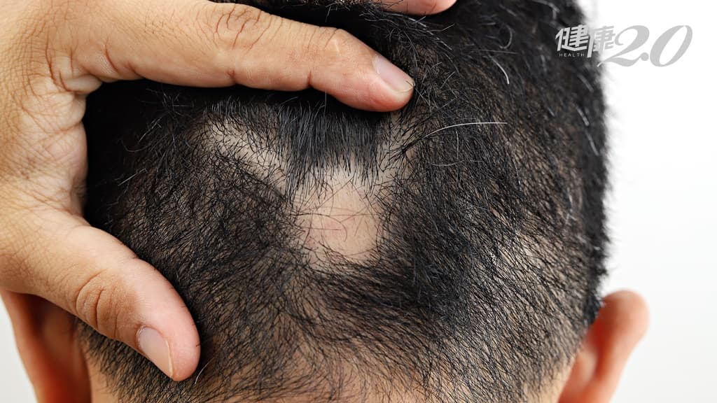 治療鬼剃頭 中醫幫你找辦「髮」！日常這樣保養 還能活絡人體經絡氣血