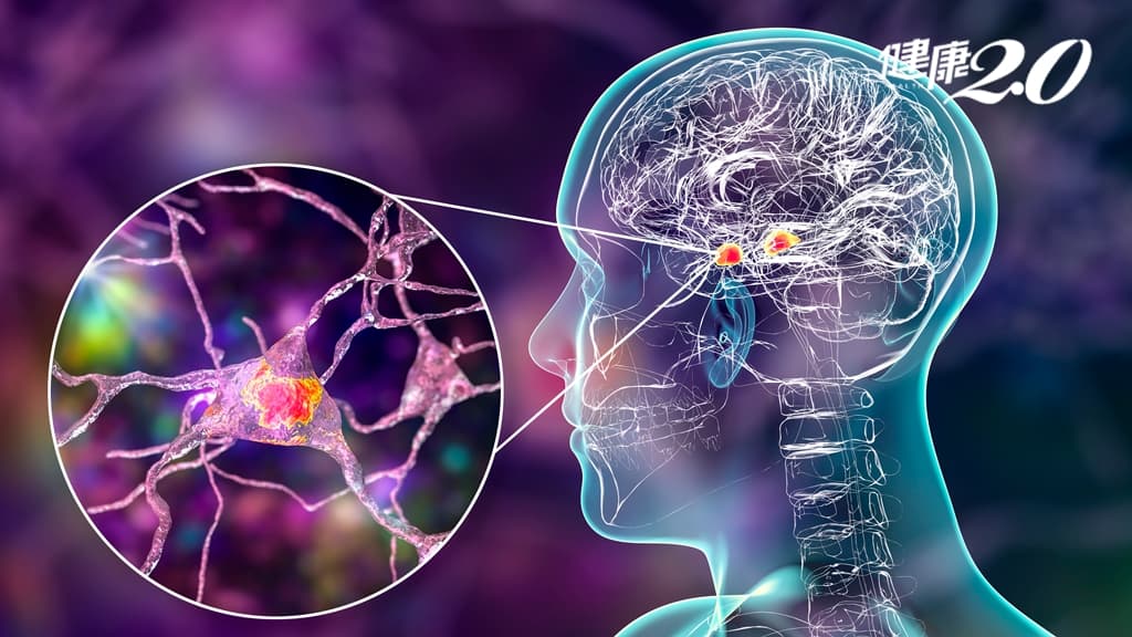 台灣新研究：降血脂藥「普羅布考」可再生腦神經 治療腦損傷後遺症