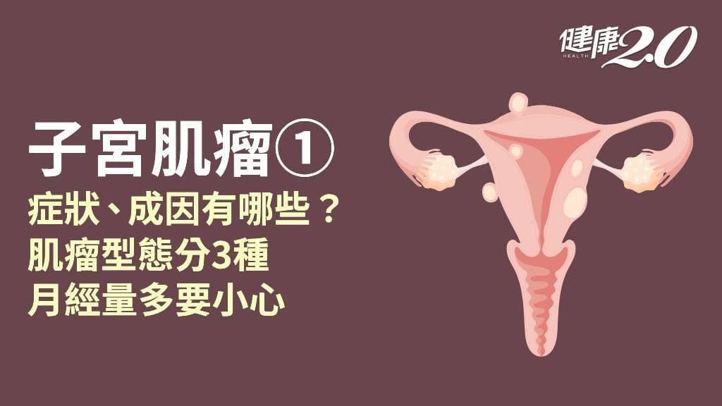 子宮肌瘤／經痛、經血量多 子宮肌瘤會造成不孕嗎？成因是什麼？會變癌症嗎？