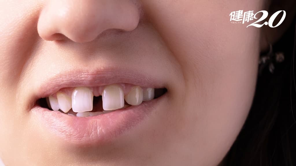 日本醫藥團隊研發新藥物 竟能幫牙齒重「長回來」？實驗已在貂身上成功