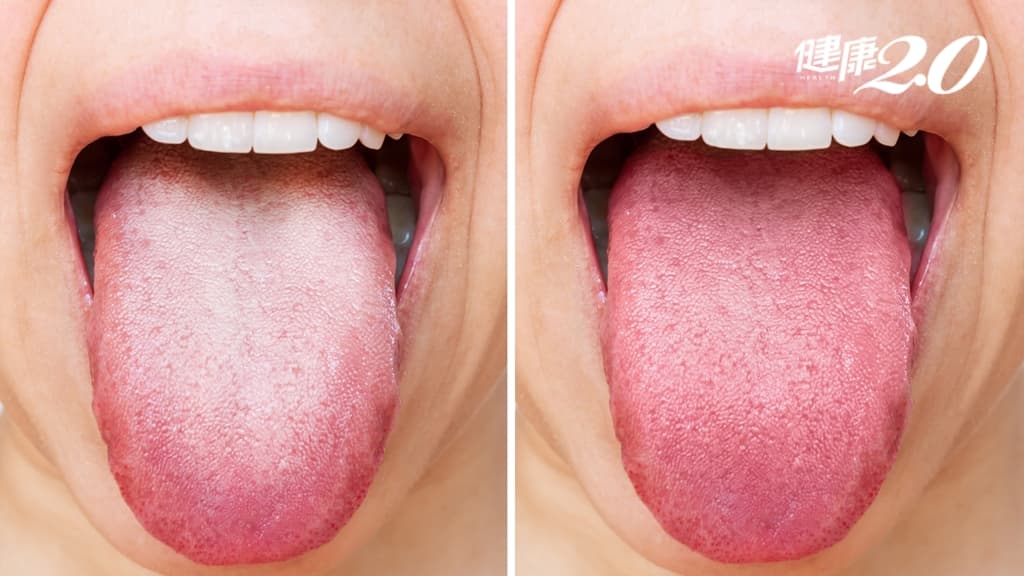 從舌頭看身體健康祕密！這種舌頭、舌苔 代表身體在發炎、濕氣重