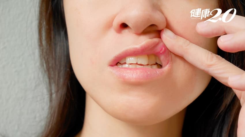 嘴破怎麼辦？嘴破藥膏怎麼選？口腔潰瘍原因、營養、治療懶人包