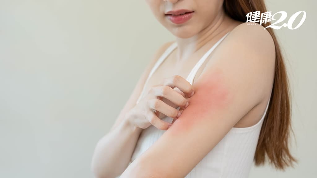 中醫幫你治療「皮在癢」！濕疹分為3類型可用3招改善 避免濕疹反覆發作