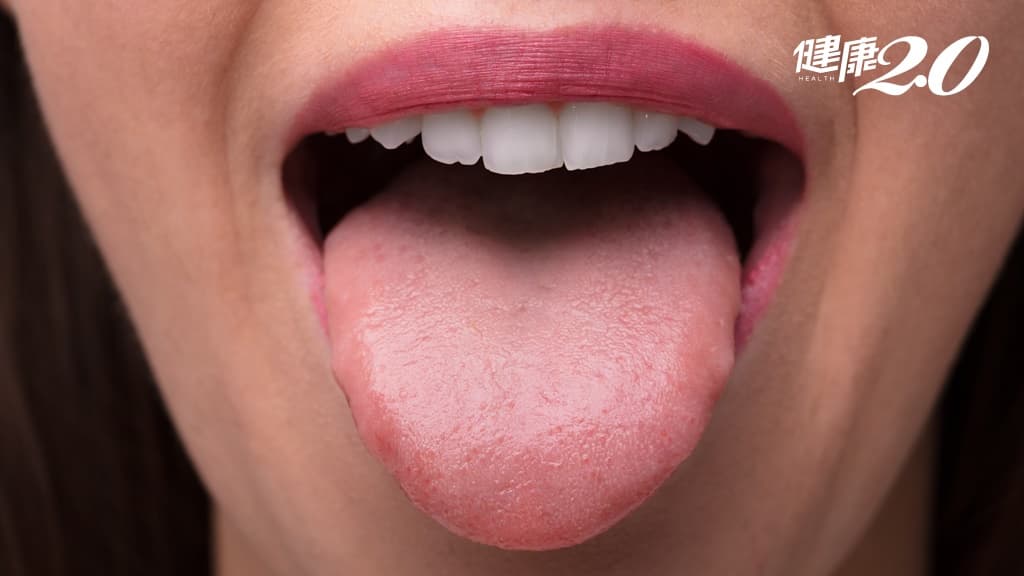 舌頭健康怎麼看？中醫：「這種」舌頭形狀當心是荷爾蒙失調、濕氣重